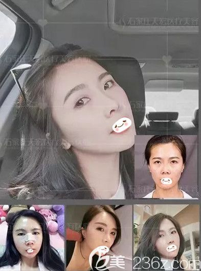 天宏整形醫(yī)院做鼻綜合和自體脂肪填充面部案例