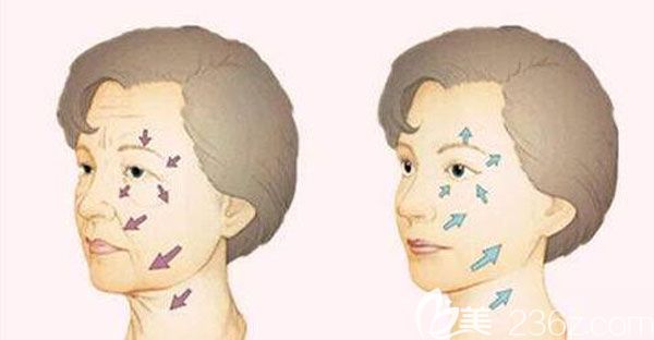 曲靖靖美趙錫泰自體脂肪面部填充和面部線雕提升的效果