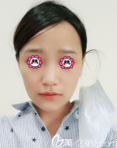 范憲紅醫(yī)生給我注射海薇玻尿酸豐唇第3天樣子 范憲紅醫(yī)生給我注射海薇玻尿酸豐唇第3天樣子