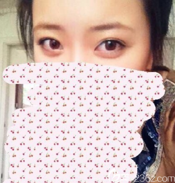 韓國(guó)MVP整形外科做雙眼皮怎么樣 韓國(guó)MVP整形外科做雙眼皮怎么樣