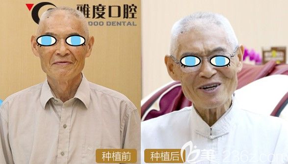 70歲老人選擇德國4D微創(chuàng)全口種植牙前后對比效果 70歲老人選擇德國4D微創(chuàng)全口種植牙前后對比效果