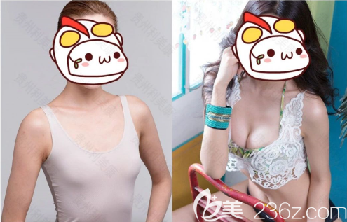 <!--<i data=20240703-sp></i>-->豐胸技術(shù)怎么樣？