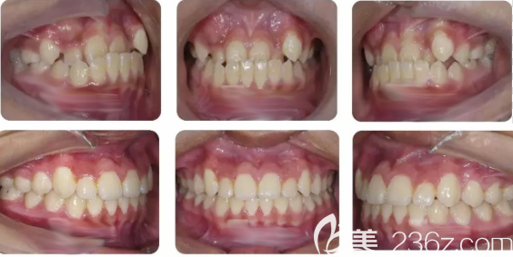 青少年地包天矯正案例效果 青少年地包天矯正案例效果