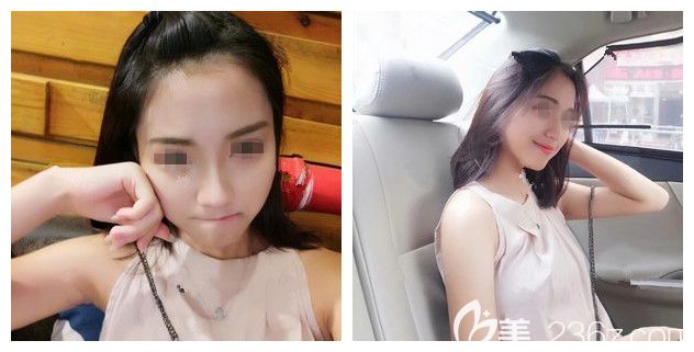 看無錫麗都真實(shí)案例鼻子效果自然，也去面診做了硅膠假體隆鼻+耳軟骨墊鼻尖改善自己的豬鼻子