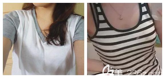 我在南寧韓星整形做隆胸手術(shù)前的照片 我在南寧韓星整形做隆胸手術(shù)前的照片