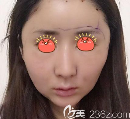 溫州瑞麗剛做完脂肪填充的圖片