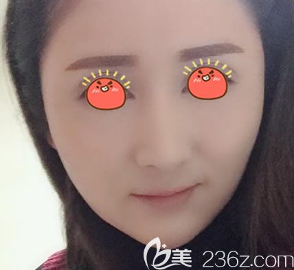 瑞安瑞麗自體脂肪填充30天后