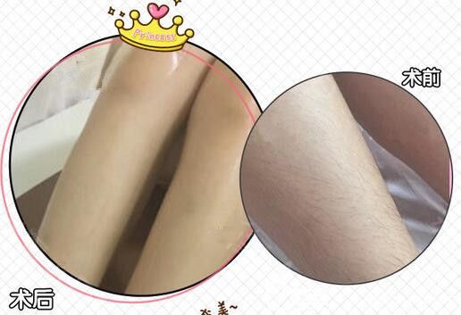 南通伊萊美激光脫毛有優(yōu)惠沒(méi)?11元可做三次冰點(diǎn)脫唇毛還有更多激光美膚劃算價(jià)格表