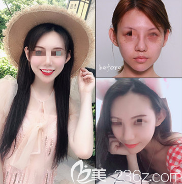 在煙臺做的激光祛斑的手術(shù)，不貴也就幾千塊而已但是效果真的讓我很驚訝