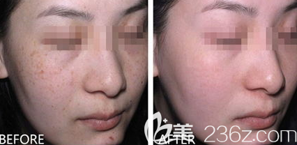 德州天宏做激光祛斑手術(shù)做的蠻干凈的，來(lái)看我的恢復(fù)日記吧