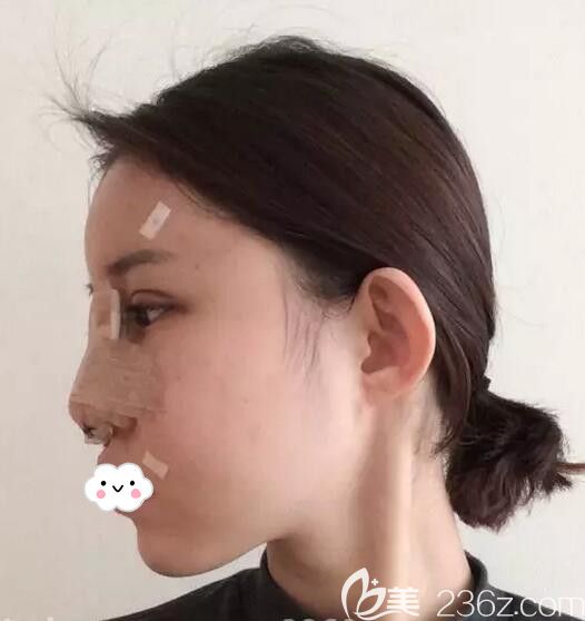 韓國歐米茄整形醫(yī)院生機(jī)脂肪移植填充全臉+鼻綜合案例術(shù)后第3天恢復(fù)圖