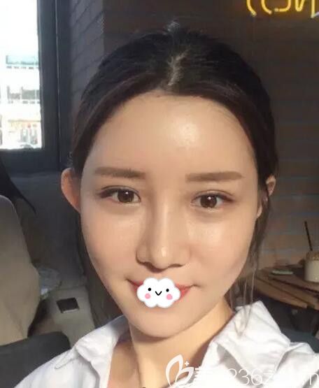 韓國歐米茄整形自體脂肪面部填充+假體隆鼻術(shù)后20天