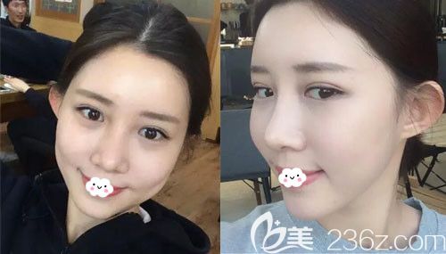 自體脂肪面部填充恢復期是多久？韓國歐米茄整形醫(yī)院生機脂肪移植+鼻綜合案例圖見證