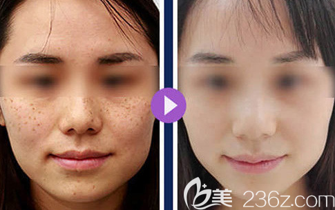 不修邊幅的我在威海做了激光祛斑手術，也不貴但是算我人生中一件很開心的大事了