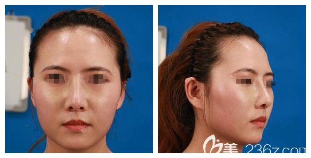 面診<!--<i data=20240703-sp></i>-->術(shù)前下頜緣松弛 面診<!--<i data=20240703-sp></i>-->術(shù)前下頜緣松弛