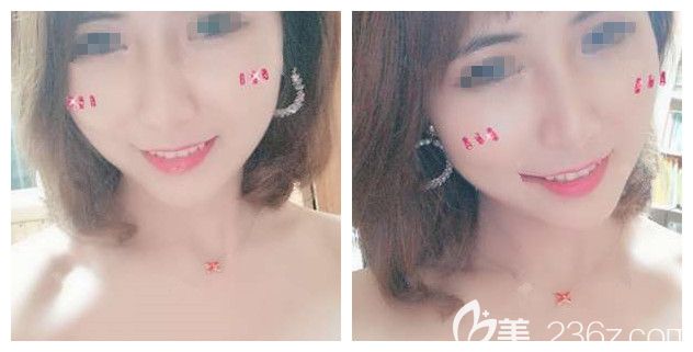 分不清楚的威寧線、韓國優(yōu)雅斯、美迪塑線材，沒想到建議了性價比較高的國產(chǎn)HS恒生下面部線雕