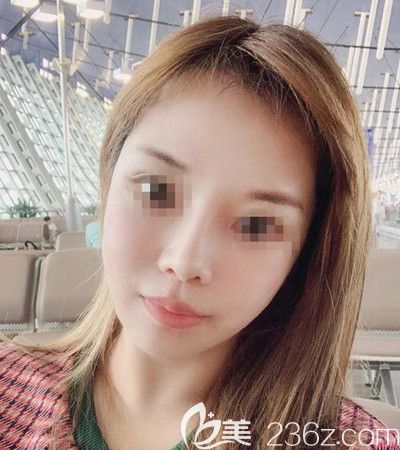 對比了幾家醫(yī)院后我選擇韓國迪美麗整形外科做了面部提升+吸脂去雙下巴手術(shù)