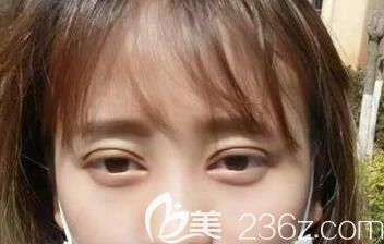 割雙眼皮第7天拆線恢復(fù)還算不錯(cuò)