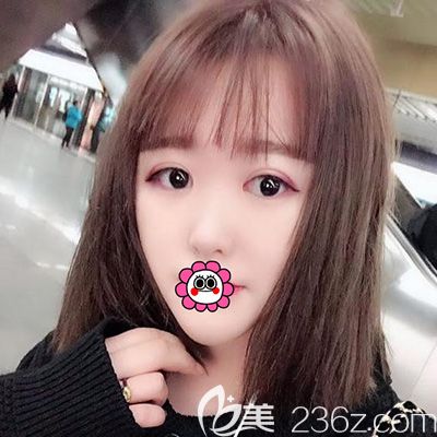 哈爾濱索菲劉剛做的芭比眼綜合恢復30天效果，大家覺著怎么樣？