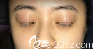 激光祛斑術(shù)前的樣子