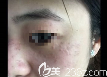 激光祛斑術(shù)后當(dāng)天的樣子