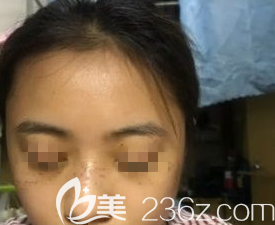 在濰坊做激光祛斑術(shù)后第5天的樣子