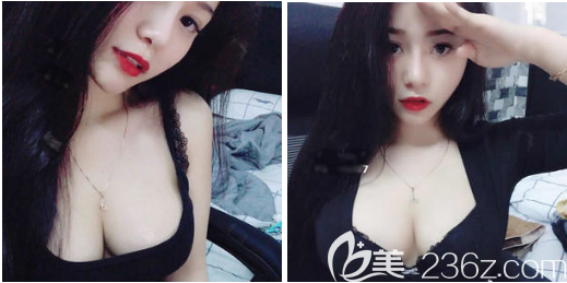 深圳富華隆胸怎么樣 深圳富華隆胸怎么樣