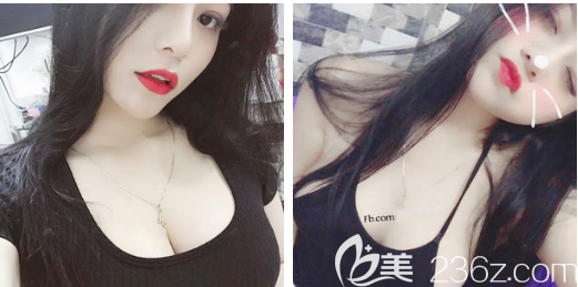 用我的假體隆胸親身經(jīng)歷告訴你深圳富華唐新輝醫(yī)生隆胸技術(shù)怎么樣