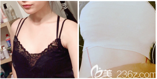 深圳富華唐新輝隆胸怎么樣 深圳富華唐新輝隆胸怎么樣