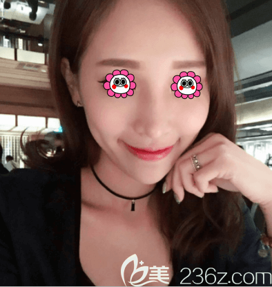 我在北京新星靚做玻尿酸填充蘋果肌后不僅沒(méi)移位而且臉型圓潤(rùn)也甜美