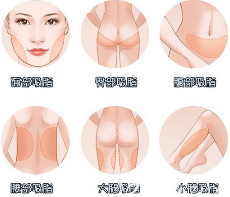 中信惠州醫(yī)院整形科吸脂項目