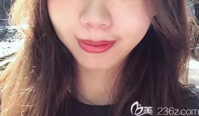 嘴凸齙牙矯正前正面的樣子 嘴凸齙牙矯正前正面的樣子