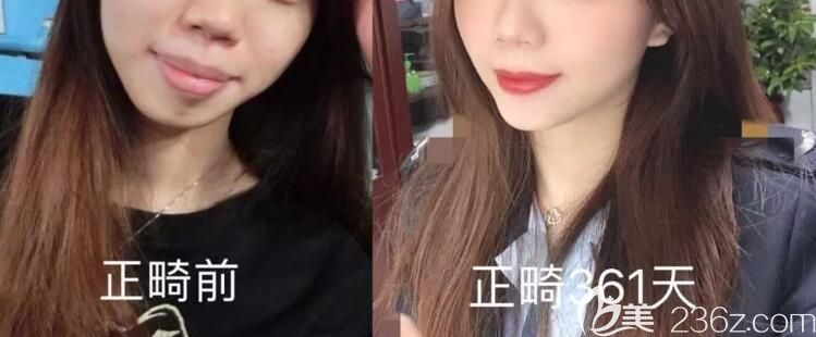 牙齒矯正361天前后對比照 牙齒矯正361天前后對比照