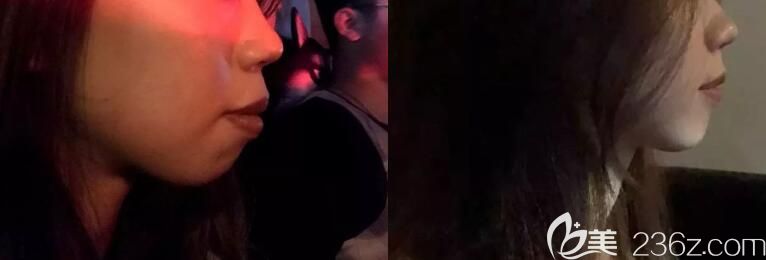 ▼齙牙矯正365天側臉前后變化對比圖 ▼齙牙矯正365天側臉前后變化對比圖