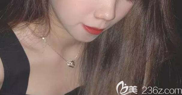 雅悅口腔矯正齙牙1年臉型圖 雅悅口腔矯正齙牙1年臉型圖