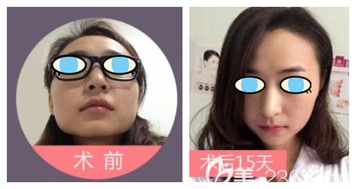 太原時光整形自體脂肪填充案例