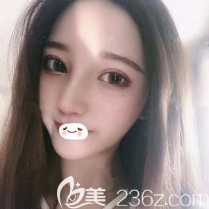 張柏松醫(yī)生為我做自體軟骨隆鼻術(shù)后22天慢慢消腫 張柏松醫(yī)生為我做自體軟骨隆鼻術(shù)后22天慢慢消腫