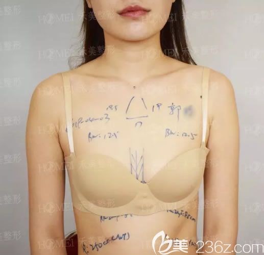 在嘉興禾美做假體隆胸術前 在嘉興禾美做假體隆胸術前