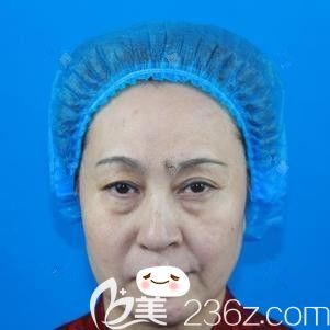 在石家莊天伊美做埋線提升術(shù)前面部顯老 在石家莊天伊美做埋線提升術(shù)前面部顯老