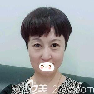 趙彥光醫(yī)生為我做埋線提升術(shù)后2天面部微腫 趙彥光醫(yī)生為我做埋線提升術(shù)后2天面部微腫