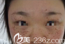 淄博激光祛斑術(shù)后即刻照片 淄博激光祛斑術(shù)后即刻照片