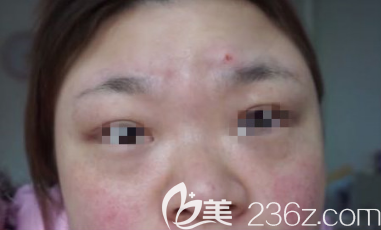 花不到兩千在淄博做了激光祛斑手術(shù)術(shù)后30天來(lái)分享照片+心得體會(huì)