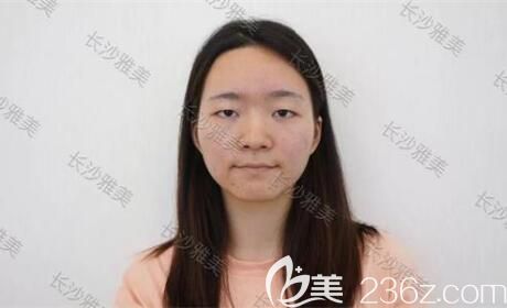 在雅美做眼鼻整形術(shù)前照 在雅美做眼鼻整形術(shù)前照