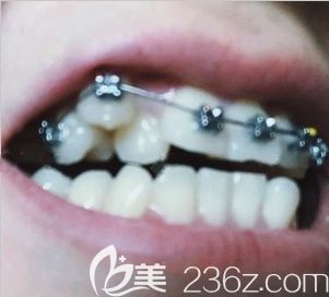 太原眾牙口腔正畸一個月時的牙齒照 太原眾牙口腔正畸一個月時的牙齒照