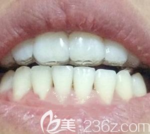 找太原眾牙口腔盧鵬做了牙齒正畸，今天來分享我戴金屬牙套矯正虎牙外凸的經(jīng)歷