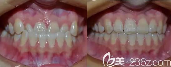 太原眾牙口腔牙齒矯正前后效果對比圖 太原眾牙口腔牙齒矯正前后效果對比圖