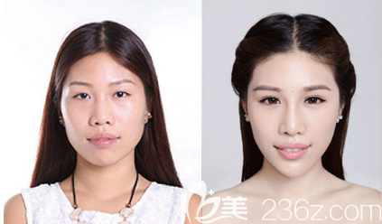 中信惠州醫(yī)院整形科陳虹醫(yī)生雙眼皮對(duì)比圖