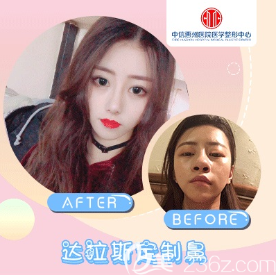 中信惠州醫(yī)院整形科陳虹醫(yī)生隆鼻對(duì)比圖