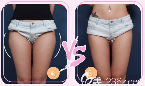 中信惠州醫(yī)院整形科陳虹醫(yī)生大腿吸脂對(duì)比圖