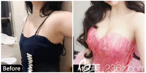 中信惠州醫(yī)院整形科陳虹醫(yī)生隆胸對(duì)比圖